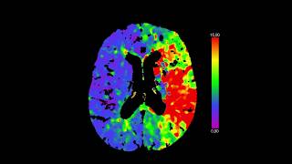 Herseninfarct acute behandelingen [upl. by Lanaj387]