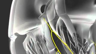 AVNRT ABLATION wwwhamilyoncom  tachycardia [upl. by Lela]