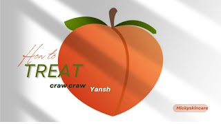 Craw craw viral video tiktok  Lapalapa yansh how to treat it without breaking the bank [upl. by Hime]