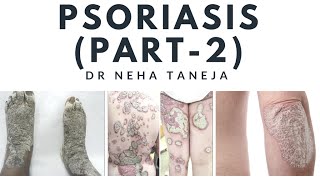 Psoriasis  Types Symptoms and Diagnosis Part  2 [upl. by Christopher]