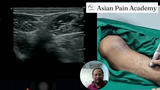 Mastering Sonoanatomy Gluteal Region Live Demo by Dr Chinmoy Roy  Asian Pain Academy [upl. by Jump]