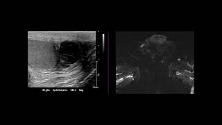 Epididymitis with abscess [upl. by Eshman]