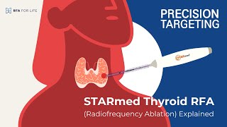 STARmed Thyroid RFARadiofrequency Ablation Explained [upl. by Sampson60]