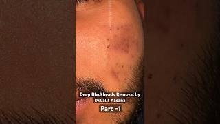 Deep Blackheads Removal part 1 drlalitkasana blackheads [upl. by Naval]