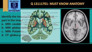 MRI Brain anatomy  Basal ganglia [upl. by Anazus]