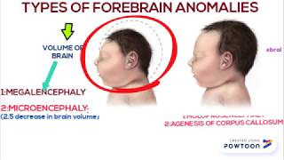 Forebrain anomalies part 1 [upl. by Ahscrop674]