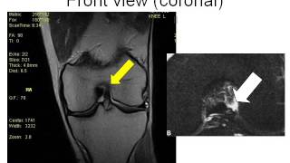 Arthroscopic Meniscus Repair of Knee Medical Surgery Patient Education [upl. by Xela]