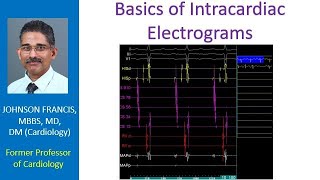 Basics of Intracardiac Electrograms [upl. by Lulita794]