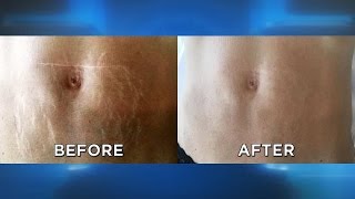 Does This Stretch Mark Removal Procedure Work [upl. by Atorod60]