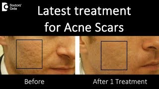 Best Treatment of Acne Scars  Dr Urmila Nischal [upl. by Zedekiah]