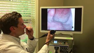 ENT flexible laryngoscopy [upl. by Llenral828]