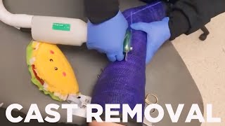 How Leg Cast is Removed  Ankle Fracture  Cast Removal Secrets [upl. by Nitsu]