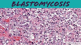 Blastomycosis 5Minute Pathology Pearls [upl. by Anne-Corinne678]