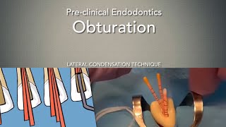 Obturation Lateral Condensation Technique [upl. by Jasmine57]