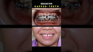 BRACES FOR GAPPED TEETH 32 MONTHS DURATION braces orthodontist dentist [upl. by Rocco]