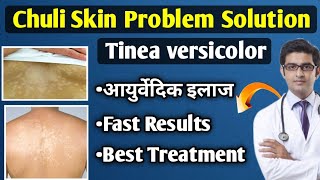 Chuli Skin Disease Treatment  Tinea Versi Color Treatment In Hindi Chuli  Review King [upl. by Yentihw]