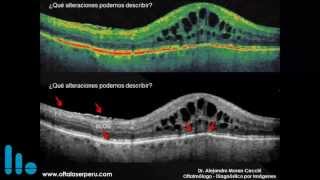Tomografías de Coherencia Óptica Imágenes en falso color versus en escala de grises  Oftalaserp [upl. by Nettle]