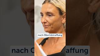 oberlidstraffung lidkorrektur lid straffung antiage düsseldorf plastischechirurgie [upl. by Lina]