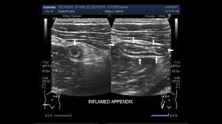 The scanning and localization of Acute Appendicitis [upl. by Rosalynd380]