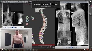 Causes of Degenerative Disc Disease Stenosis and Arthritis [upl. by Olwen]