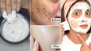 3 Days Skin TransformationGet rid of skin blemishes spots large poresget bright tight glass skin [upl. by Leschen928]