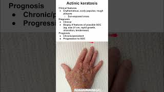 Treating Actinic Keratosis with Fluorouracil 5 [upl. by Inigo]