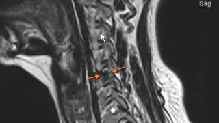 Typical disc herniation of cervical spine [upl. by Lednor]