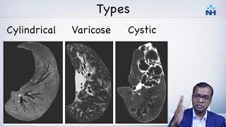 CT imaging and diagnosis of Bronchiectasis [upl. by Teahan]