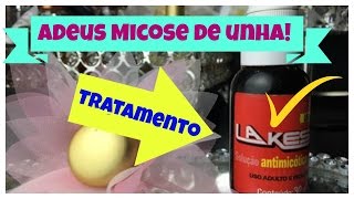 Acabei com a micose nas unhas usando LAKESIA 2016 [upl. by Ainat807]