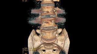 A Case of Double Failed Lumbar Fusion and Dangerously Misplaced Pedicle Screws [upl. by Uttica547]