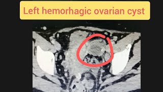 Left Ovary Cyst CT scan [upl. by Eednyl]