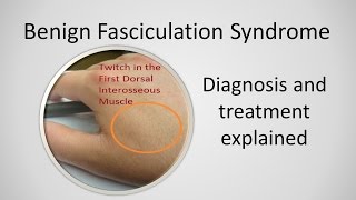 Benign Fasciculation Syndrome Causes and Treatment [upl. by Zalea]