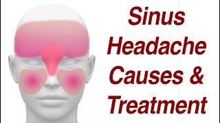 Sinus Headaches Causes amp Treatment [upl. by Hermine]