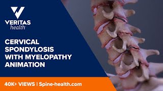 Cervical Spondylosis with Myelopathy Animation [upl. by Merilee]