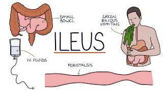 Basics of Radical Cystectomy and Ileal Conduit [upl. by Steven]