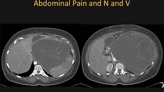 Mucinous Cystic Neoplasm MCN of the Pancreas What You Need to Know – Part 2 [upl. by Einnil]