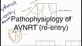 Supraventricular Tachycardia  AVNRT  AVRT [upl. by Ecinuahs]