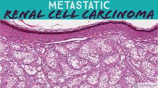 Metastatic Renal Cell Carcinoma RCC in Skin 5Minute Pathology Pearls [upl. by Justina]