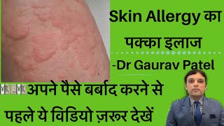 स्किन ऐलर्जी का इलाज।Skin Allergy Treatment At Home By Dermatologist Dr Gaurav Patel skinallergy [upl. by Attelra]