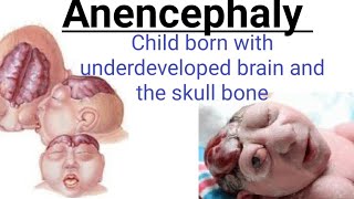 Anencephaly  Child born with underdeveloped brain and the skull bone [upl. by Rofotsirk155]