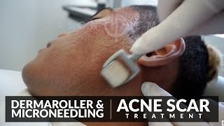 Microneedling for Acne Scars Treatment  Dermaroller Before and After  Skin Resurfacing  Dr Jason [upl. by Carolynn]