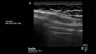 Diaphragmatic scanning using USG  ABCDE technique [upl. by Freeborn]