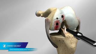 Partial Knee Replacement Surgery for Ultra Runner 3month postop [upl. by Kask]