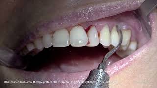 PROPHYLAXIS  Dr Gianluca Russo  Maintenance periodontal therapy [upl. by Enytsirhc]