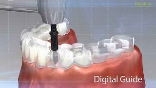 Dentium Digital Guide [upl. by Yorgerg]