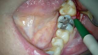 flap design in 3d molar extraction [upl. by Niple]