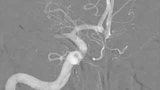 Endovascular thrombectomy and neuroprotection in large core stroke [upl. by Notrub247]