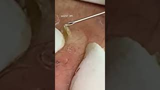 Pickel Ausdrücken Blackheads Mitesser Entfernung 🔴 61 [upl. by Aigroeg]