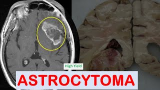 Brain Tumors Part1 Astrocytoma [upl. by Shelbi858]