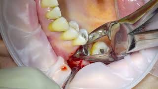 Removal of an Infected Dental Implant [upl. by Lola]